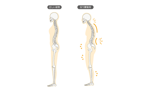 正しい姿勢と反り腰猫背の画像